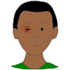 Pink eye Picture