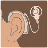 cochlear+implant Picture