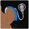 Cochlear Implant Picture