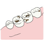 Cavities Picture