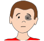 Black Eye  Picture