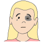 Black Eye  Picture